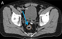 Initial Planning Session, Prostate SBRT Treatment on ETHOS