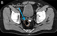 Day of treatment, Prostate SBRT Treatment on ETHOS