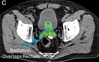 Non-adaptive treatment, Prostate SBRT Treatment on ETHOS