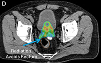 Adaptive treatment, Prostate SBRT Treatment on ETHOS