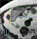 Sparing bowel high dose SBRT