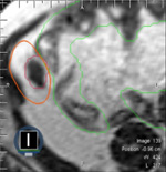 Sparing bowel high dose SBRT