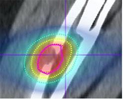 Bone metastasis undergoing BgRT with real-time PET-guided targeted therapy with representative planning tumor volume (pink) and isodose lines