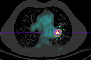 Perihilar/lung metastasis undergoing BgRT with real-time PET-guided targeted therapy with representative planning tumor volume and isodose lines