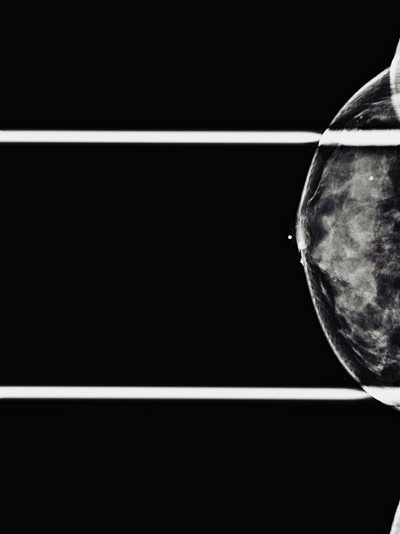 Mammograph photo of a patient, not enrolled in any of the trials, with stage 1 hormone-positive breast cancer.