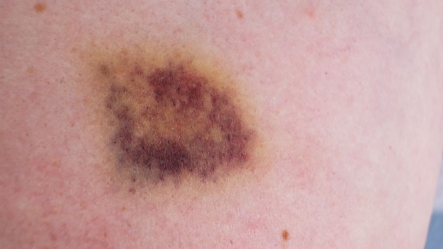 Close up image of a leukemia bruise