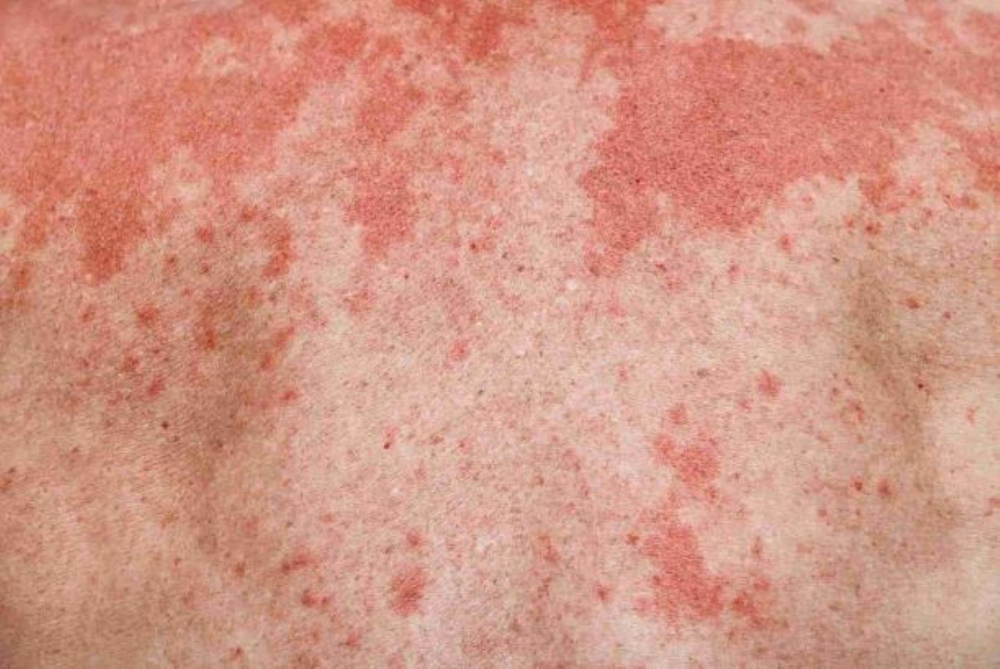 Close up image of a leukemia rash