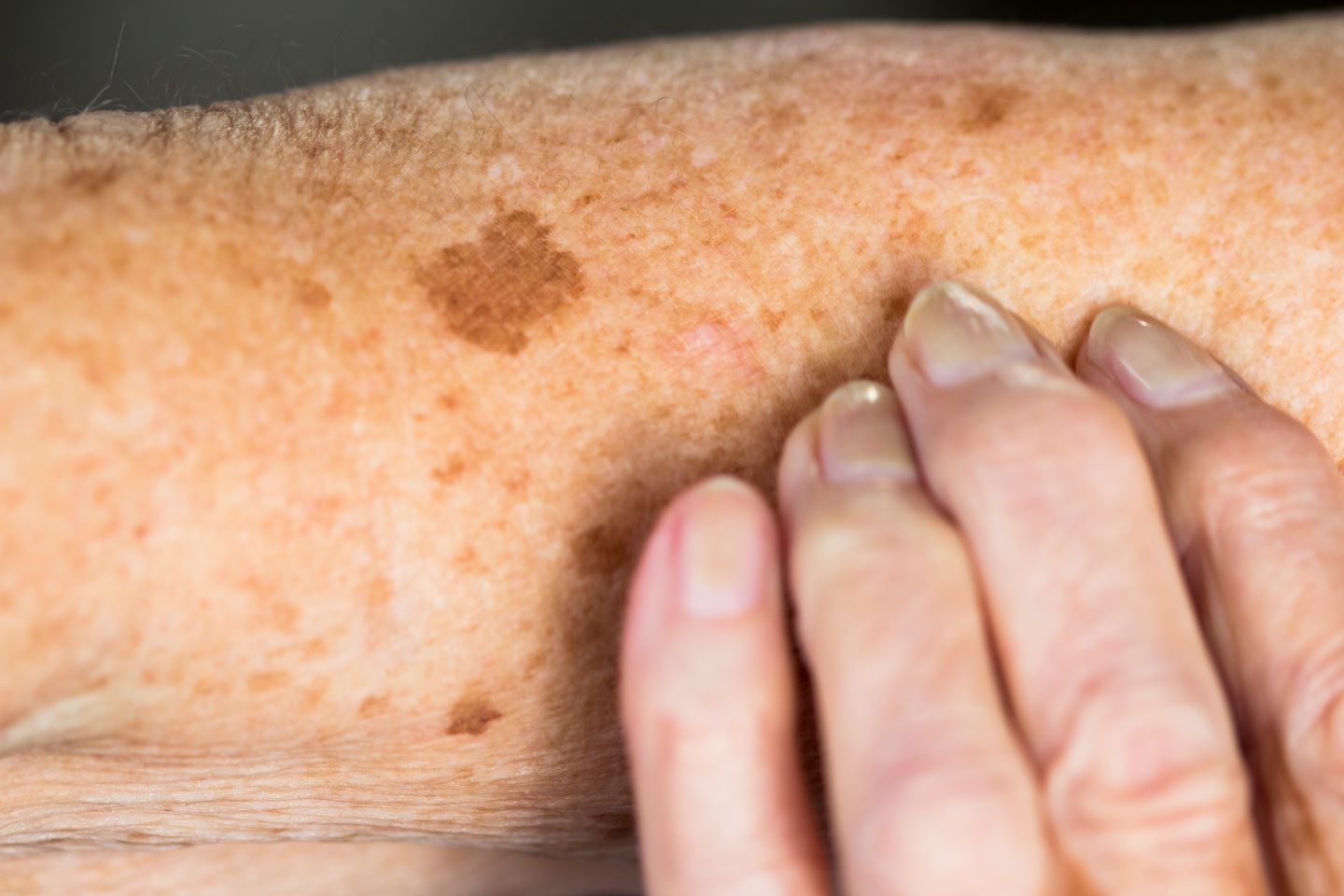Leukemia spot on a person's arm