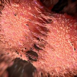 Prostate cancer