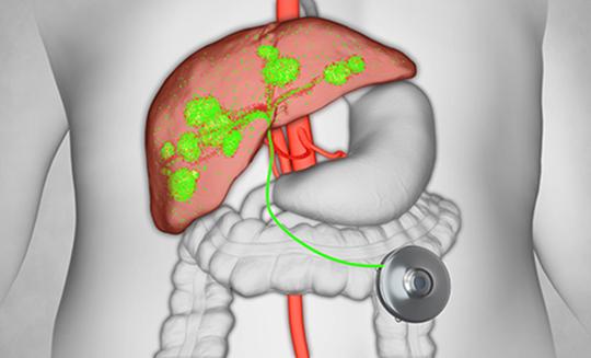 Illustration of how HAI therapy works
