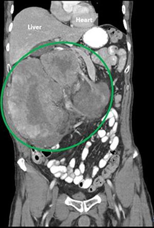 Imaging for retroperitoneal sarcoma