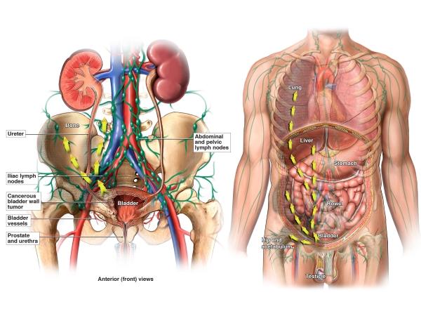 Side by side images describing the metastasis of a high-grade muscle invasive bladder cancer through the circulatory and lymphatic systems.