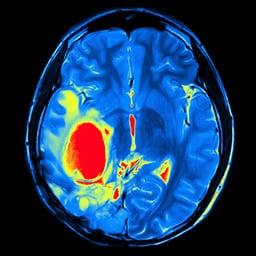 brain tumor 