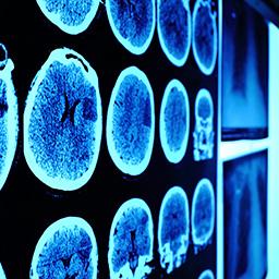 Breakthroughs - brain cancer 2016 - 256x256