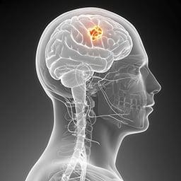 Breakthroughs - brain cancer research Breakthroughs - brain cancer research