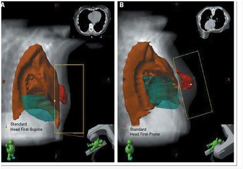 breast-cancer-respiratory-gating-500x349