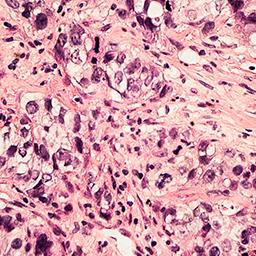 breast cancer cells JANDIAL 256 x 256