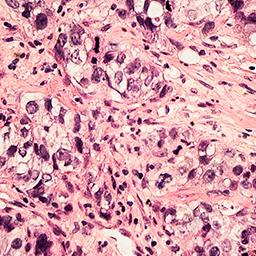 breast cancer cells JANDIAL 256 x 256 breast cancer cells JANDIAL 256 x 256
