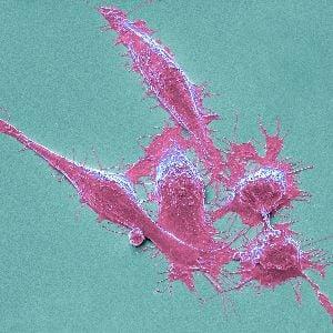 Colorectal cancer cells Colorectal cancer cells