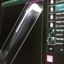 Magnetic Prosthesis | City of Hope