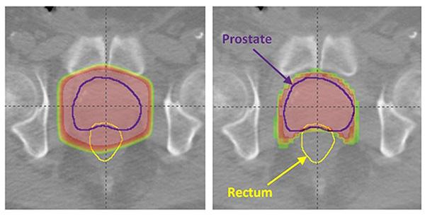 Imaging of prostate cancer radiation therapy using tomotherapy vs. 3DCRT