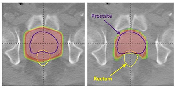 prostate-tomo-3dcrt-600x304