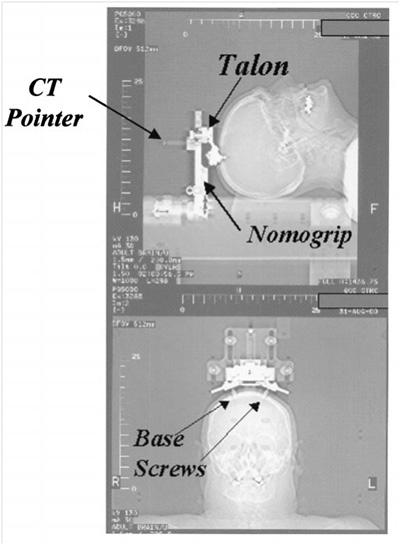 radonc-brain-w-nomogrip-400x545 radonc-brain-w-nomogrip-400x545