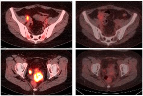 radonc-gyn-tomotherapy-475x320