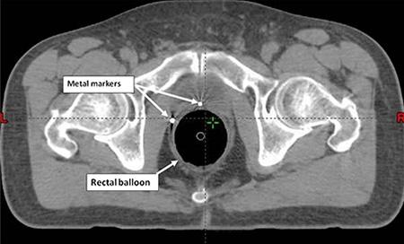 radonc-prostate-markers-balloon-450x272
