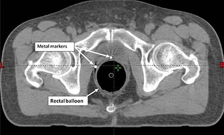 Stereotactic body radiation therapy imaging of a patient with prostate cancer