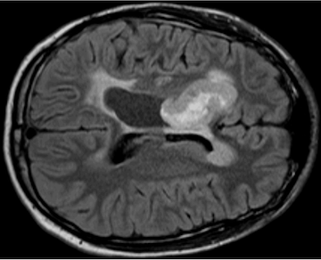 Leo Wang Research Pediatric Brain Tumor
