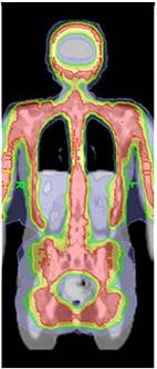 Tomotherapy total marrow irradiation