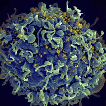 Scanning electron micrograph of HIV particles infecting a human H9 T cell.