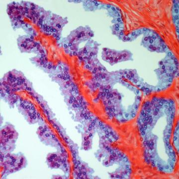 Prostate cancer light micrograph