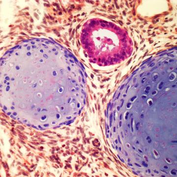 Testicular cancer cells