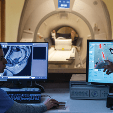 Exblate Prostate