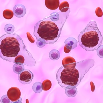 myelofibrosis