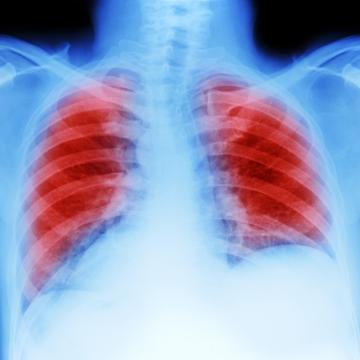 Lung cancer scan