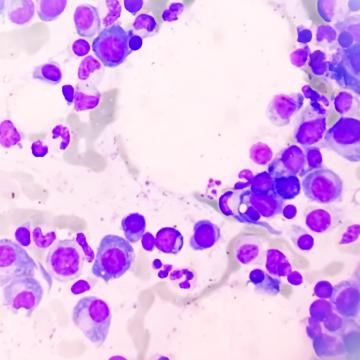 myeloma