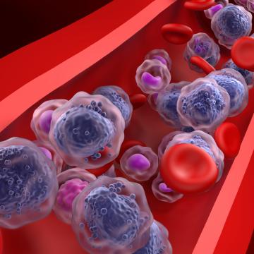 Acute myeloid leukemia illustration