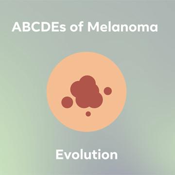 Illustration of a cancerous mole 