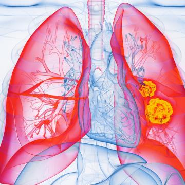 lung cancer