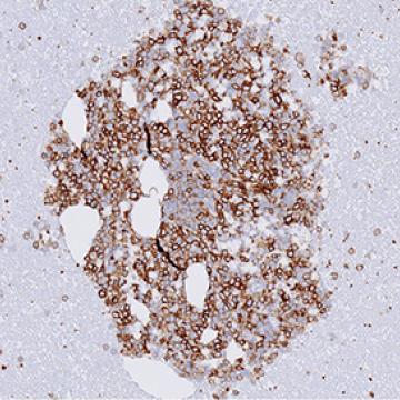image of Expression of CD84 in AML primary patient