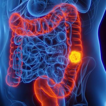 Colorectal cancer screening image