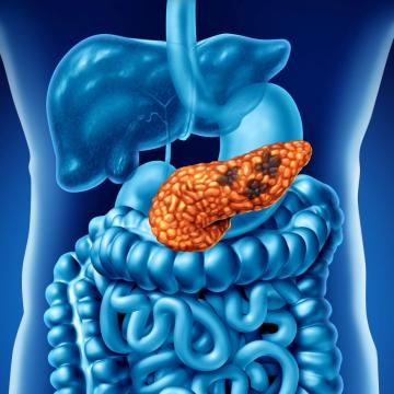 Image of internal human organs, highlighting a cancerous pancreas 