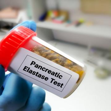 Lab technician holding pancreatic elastate test sample
