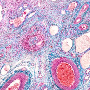 How FRα testing is expanding treatment options for ovarian cancer