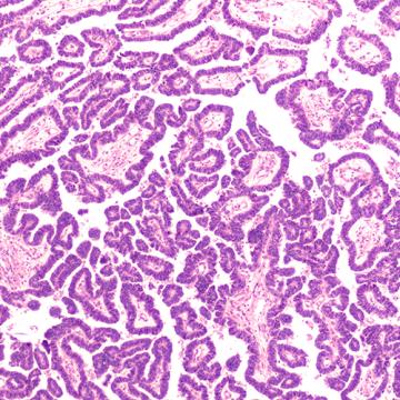 Platinum resistant ovarian cancer cells under microscope