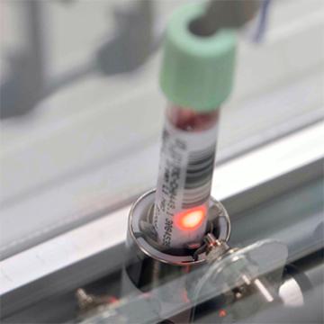 New Study: Blood Test Shows Promise for Detecting Pancreatic Cancer at Its Earliest Stages
