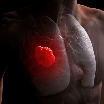 3D rendering of lung cancer cells in a man's chest